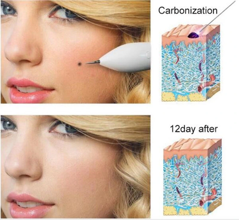 Mole Spot Removal Eyelid Lifting Fibroblast Plasma Pen